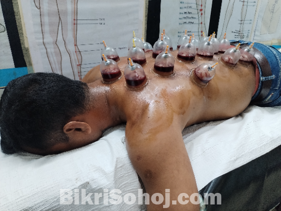 Hijama acupuncture treatment